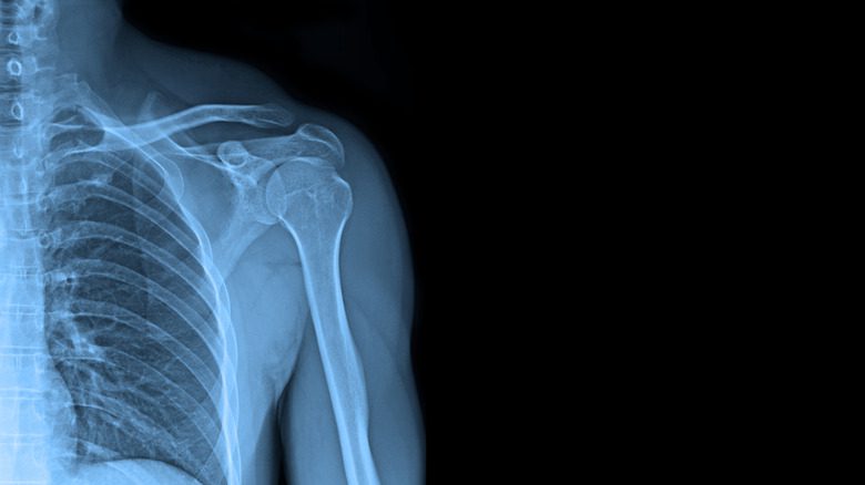 Рентгеновские снимки плечевого сустава, позволяющие увидеть повреждения сухожилий и костей для постановки медицинского диагноза