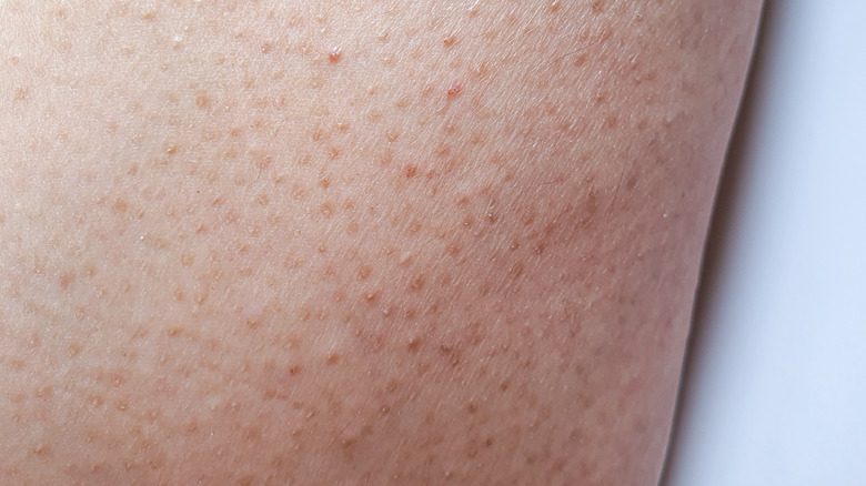 Кожа в состоянии keratosis pilaris