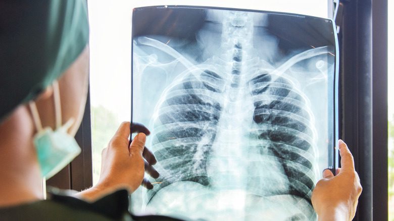 Врач изучает рентгеновский снимок грудной кости