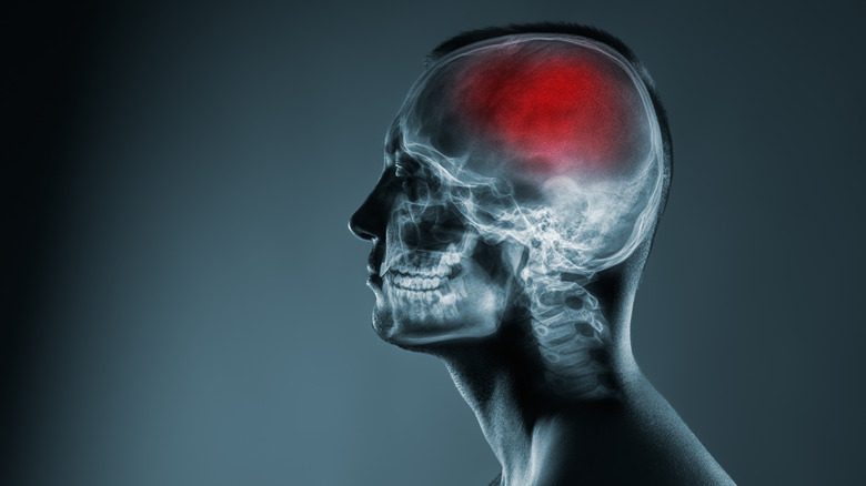 рентгеновский снимок мозга при боли